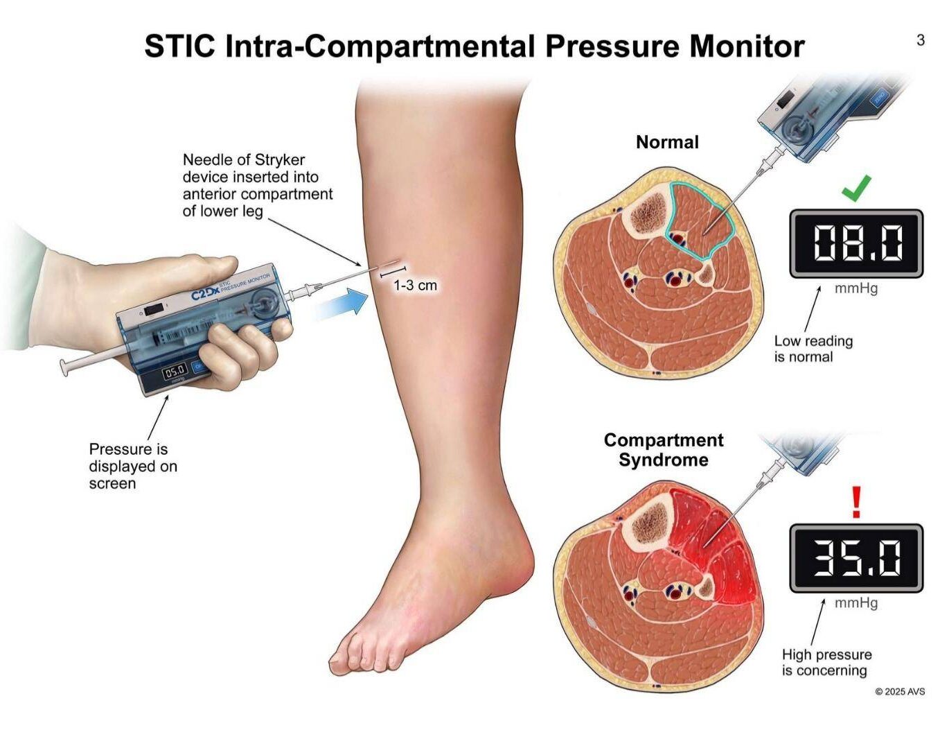 Manometer method for compartment pressure measurement
